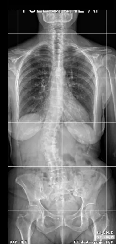 Radiografia della colonna in proiezione frontale con scoliosi di 25 gradi