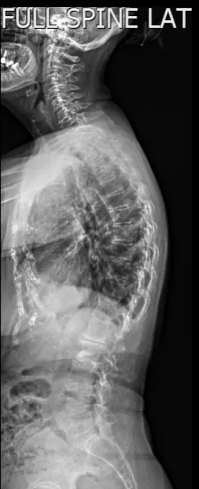 Radiografia della colonna in proiezione laterale